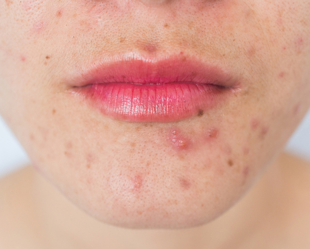 Trị Mụn Viêm Mụn Mủ Tại Sen Beauty